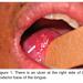 Squamous Cell Carcinoma of the Tongue in A Patient with Rothmund-Thomson Syndrome (Recq4 Mutation) - Intolerance to Radiotherapy